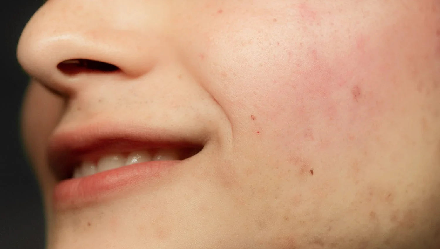 What Is the Skin Microbiome - And Why Is Yours Out of Balance?