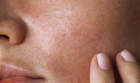 How Air-Conditioning Is Silently Destroying Your Skin Barrier in Singapore
